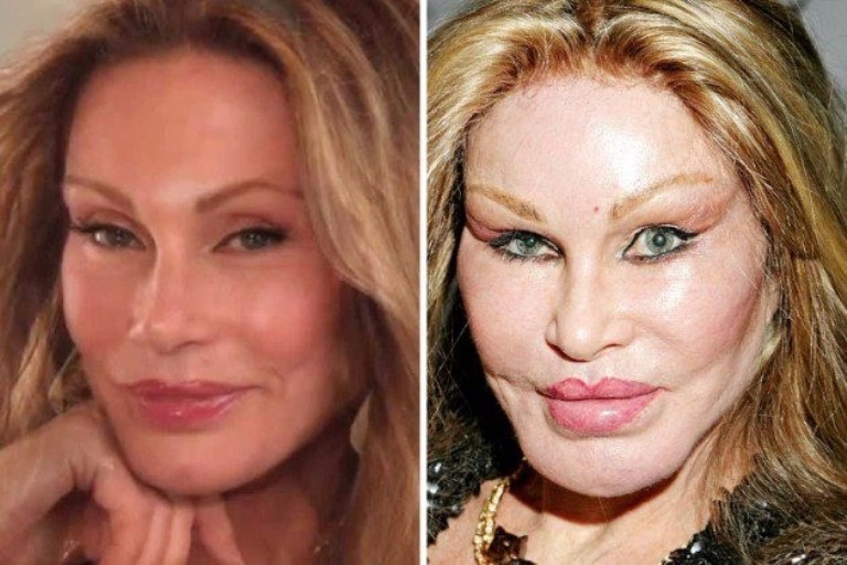 10 Celebrity Plastic Surgery Disasters You Need To See