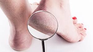 Cara Mengatasi Kaki Pecah-Pecah Biar Halus Lagi Tanpa Ribet