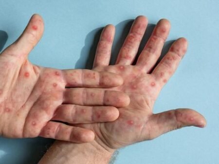 Wajib Kamu Tahu! Inilah Tips Ampuh Biar Nggak Tertular Campak