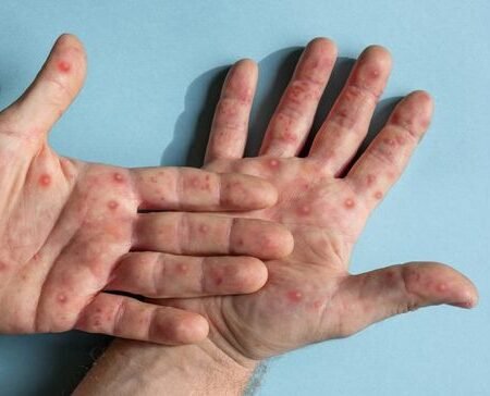 Wajib Kamu Tahu! Inilah Tips Ampuh Biar Nggak Tertular Campak