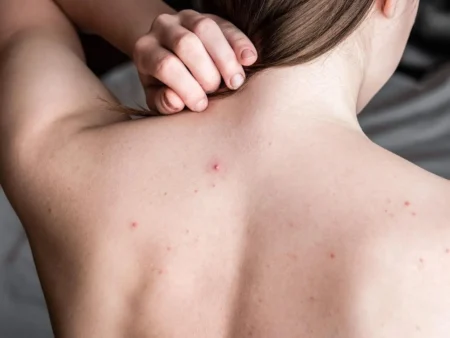 Bye Jerawat Punggung! Cara Mencegahnya Biar Kulit Tetap Bersih dan Nyaman