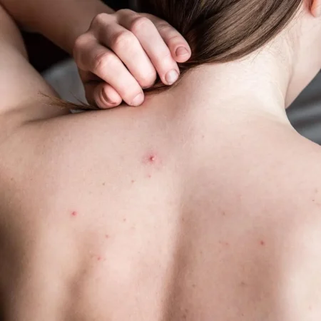 Bye Jerawat Punggung! Cara Mencegahnya Biar Kulit Tetap Bersih dan Nyaman