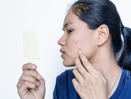 Cara Alami Menghilangkan Jerawat, Simpel Tapi Efektif Bikin Wajah Makin Bersih