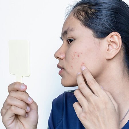 Cara Alami Menghilangkan Jerawat, Simpel Tapi Efektif Bikin Wajah Makin Bersih