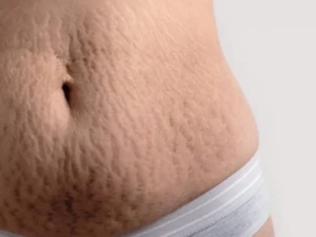 Stretch Mark Muncul Setelah Hamil? Ini Cara Alami yang Bisa Dicoba di Rumah