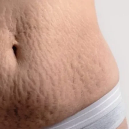 Stretch Mark Muncul Setelah Hamil? Ini Cara Alami yang Bisa Dicoba di Rumah